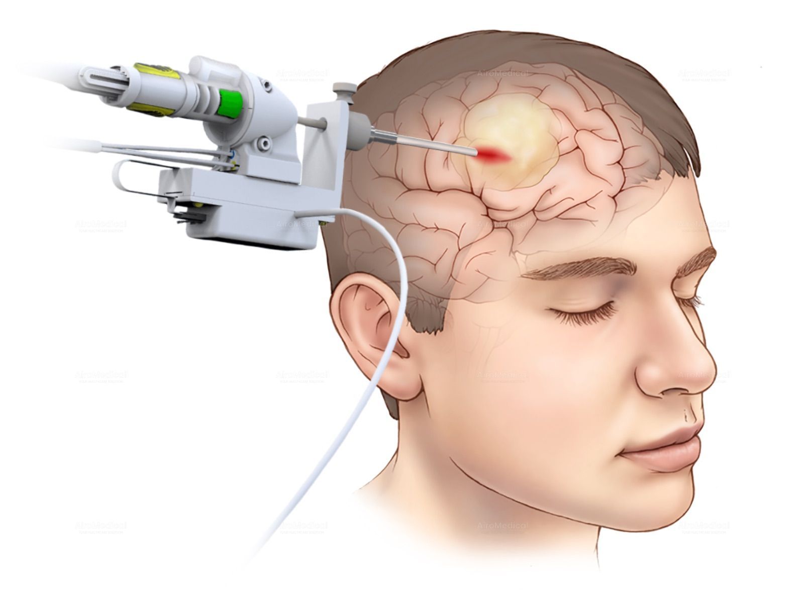 Brain cancer treatment with MRI-guided stereotactic laser ablation