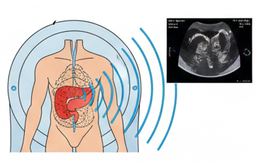 MR-Guided Focused Ultrasound for Pancreatic Cancer