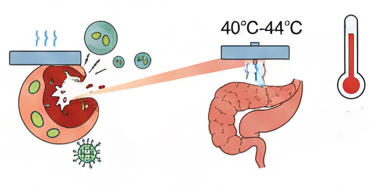 Hyperthermia for Pancreatic Cancer
