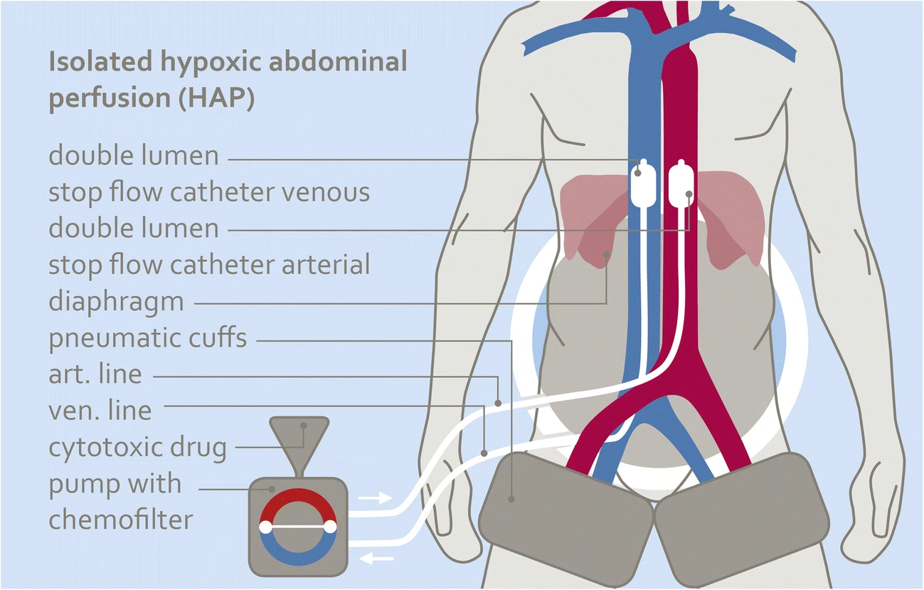 Isolated Hypoxic Abdominal Perfusion