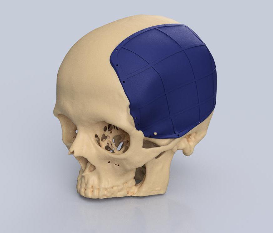 Example of Individual CAD Cranial Implant as Done for Elza Ujkani in Germany