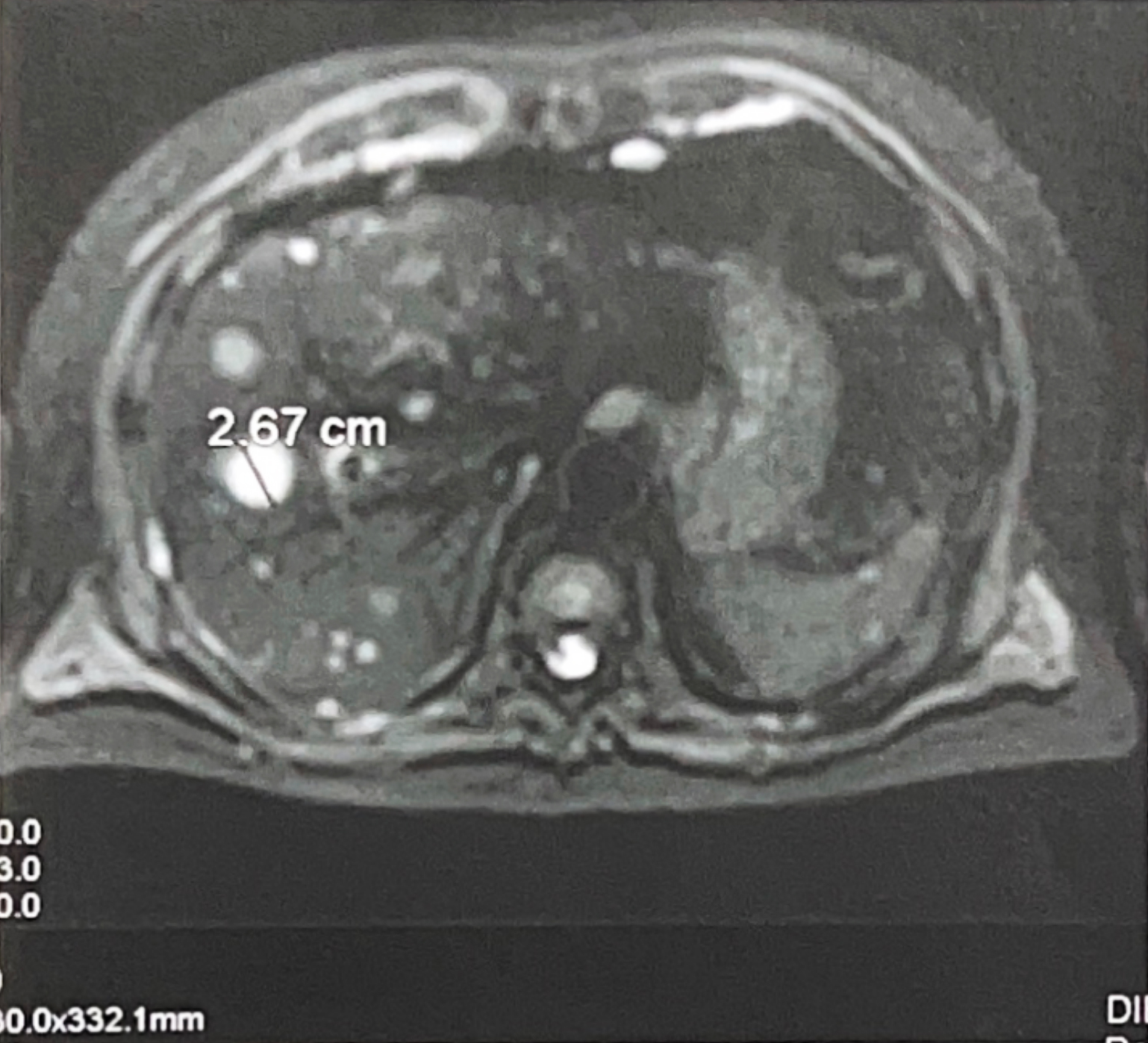 Liver MRI Scan Showing Liver Metastatic Tumor (Scan Before The Procedure)