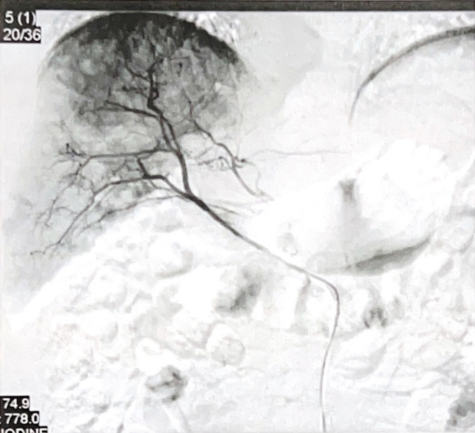 Transarterial Chemoembolization for The Liver Lesion