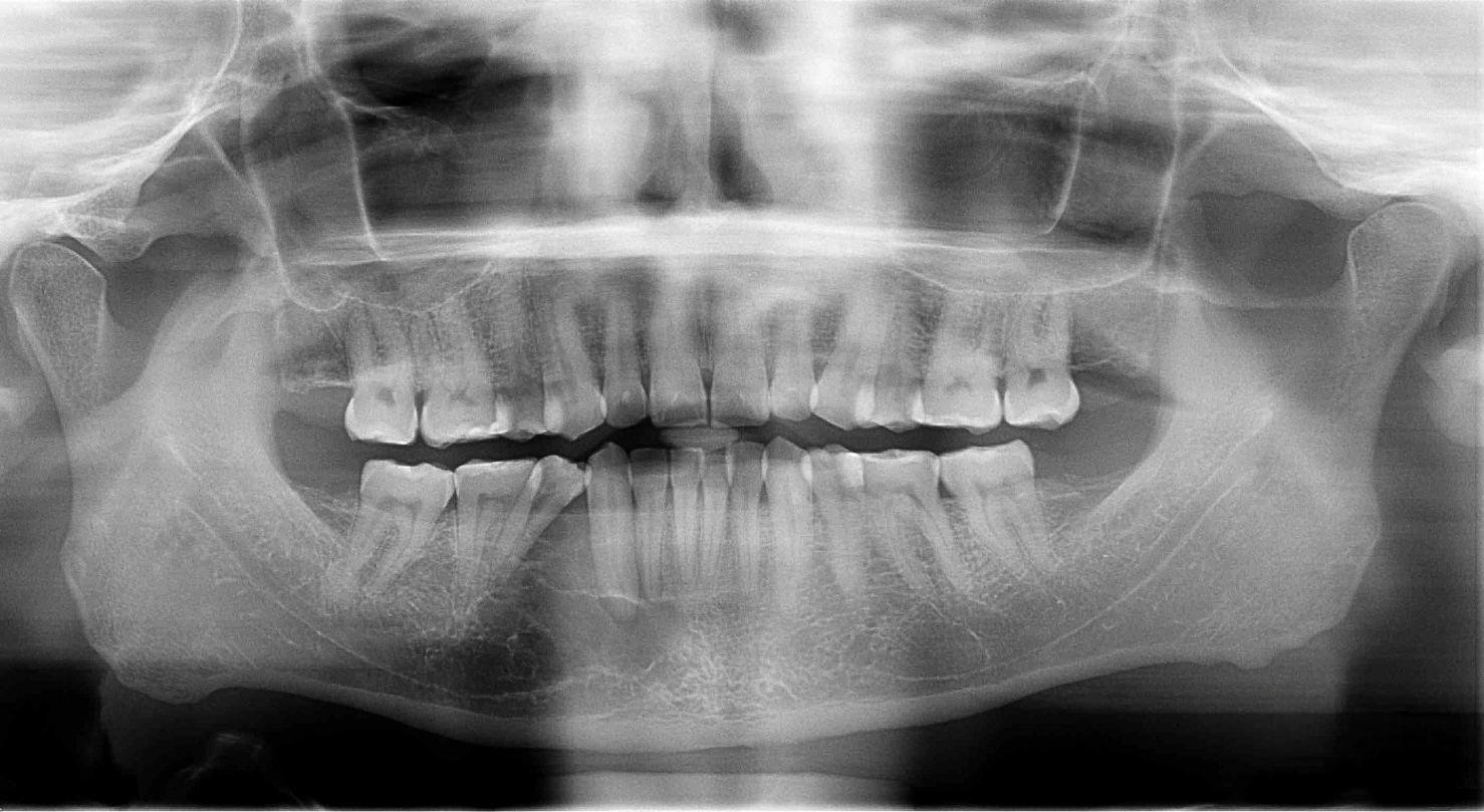 Initial X-ray Showed Odontogenic Myxoma of the Right Mandible