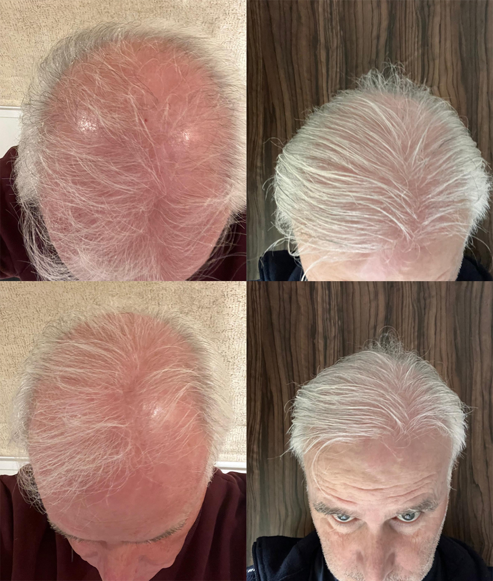 Hair Transplant Results Before (Left Side) & After (Right Side)