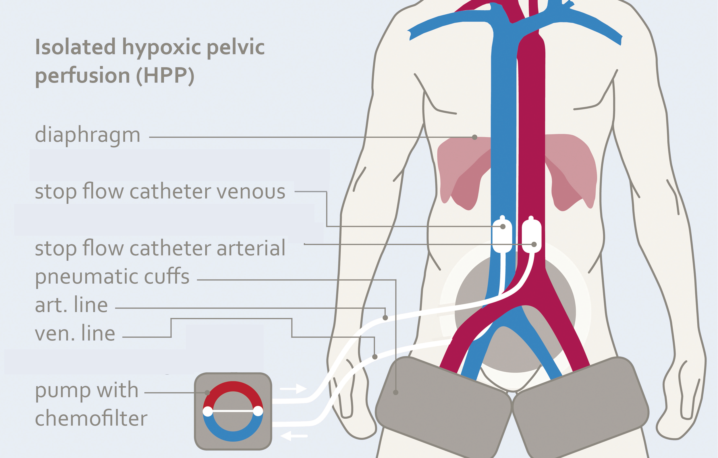 Diagram of isolated hypoxic pelvic perfusion (HPP)