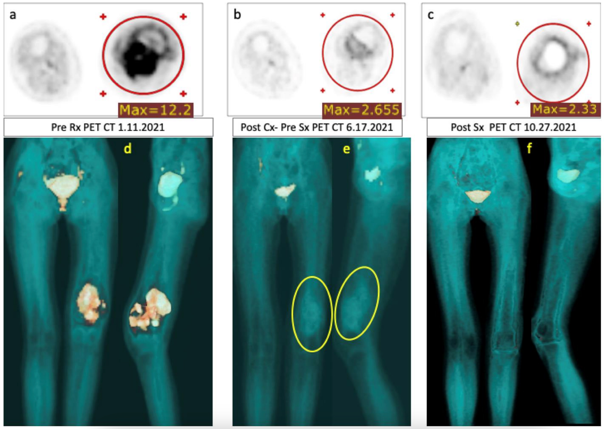 Timeline of tumor reduction during the different EISLI cycles