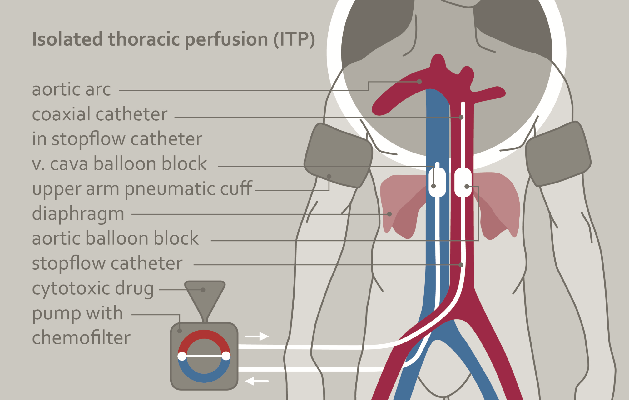 Scheme of Isolated Thoracic Perfusion with Chemofiltration (ITP-F)