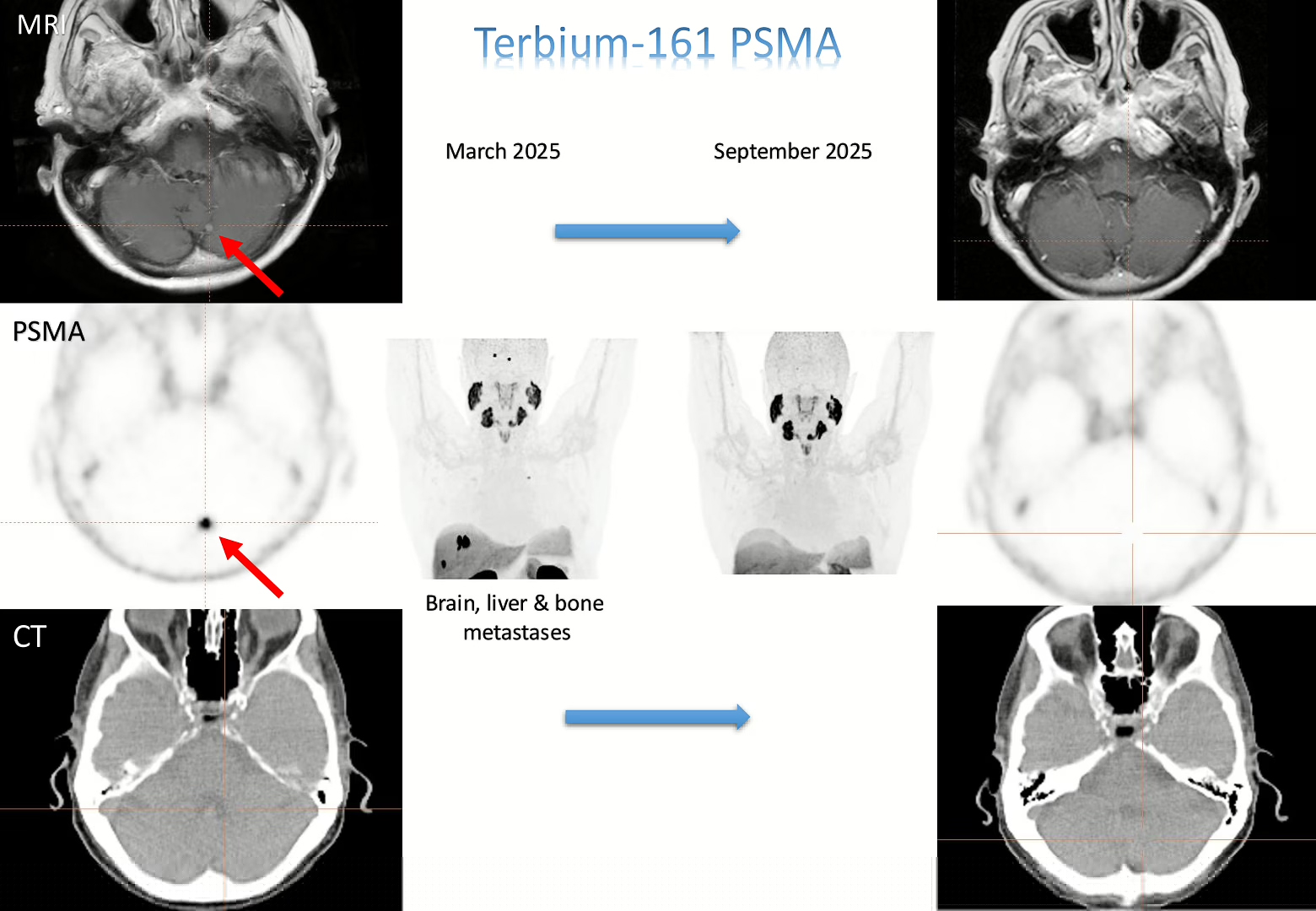 Results of Terbium-161 PSMA Therapy at MINUTE Medical in Vienna Austria
