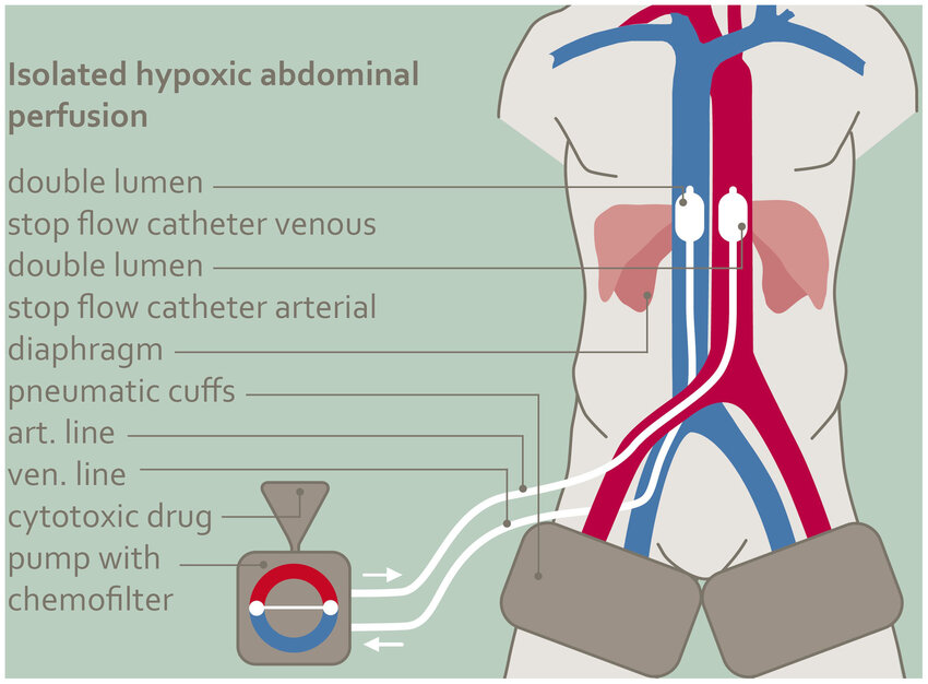 Isolated Hypoxic Abdominal Perfusion