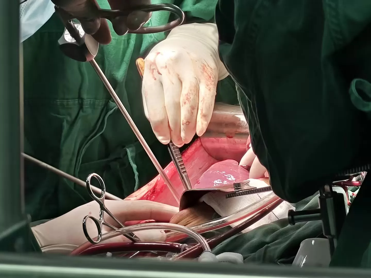 The Surgical Process on Beating Heart in Beijing Jingdu Children's Hospital