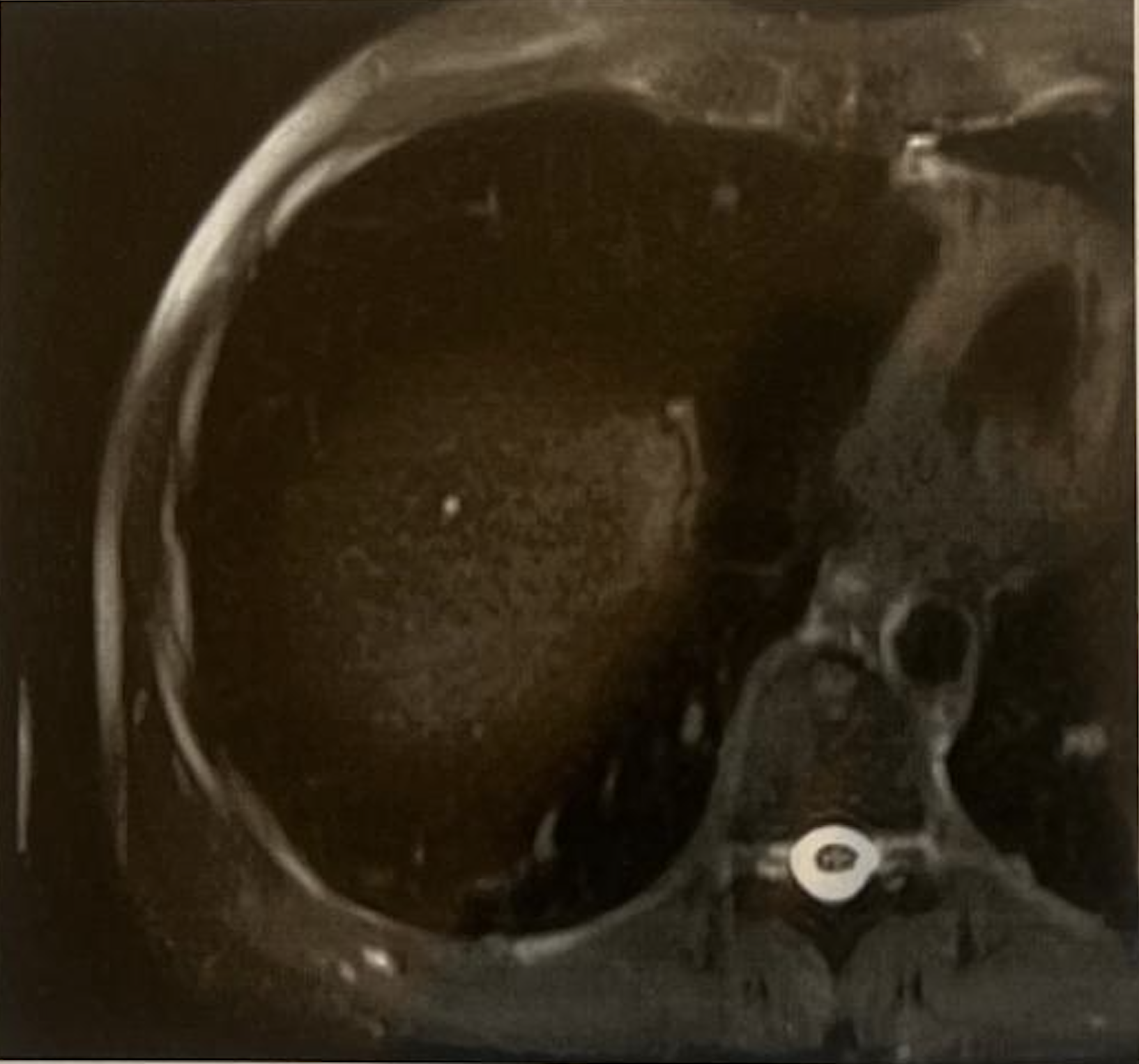 CT scan During Transpulmonary Chemoembolization Provided by Prof. Vogl
