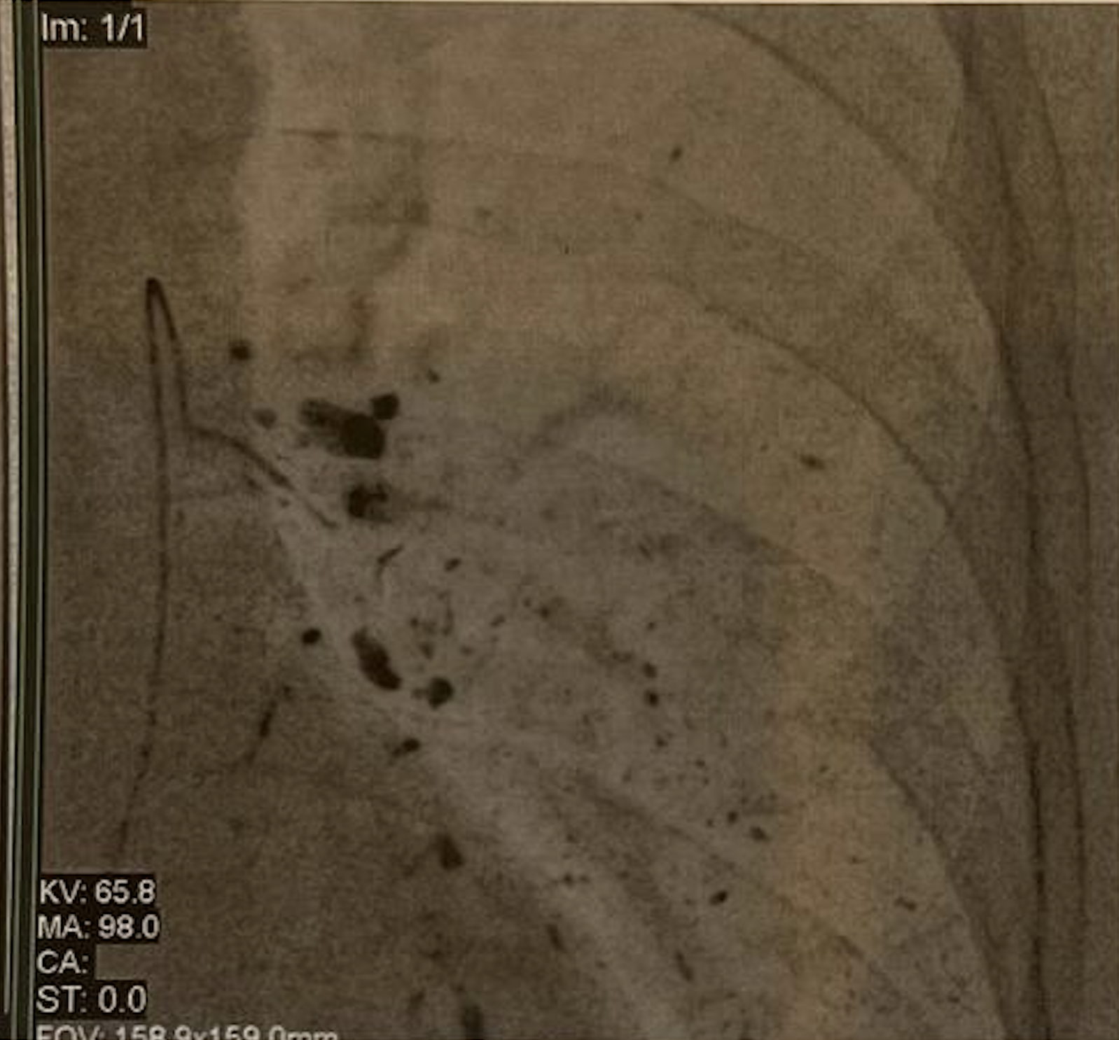 During TPCE for Airomedical Patient in Frankfurt