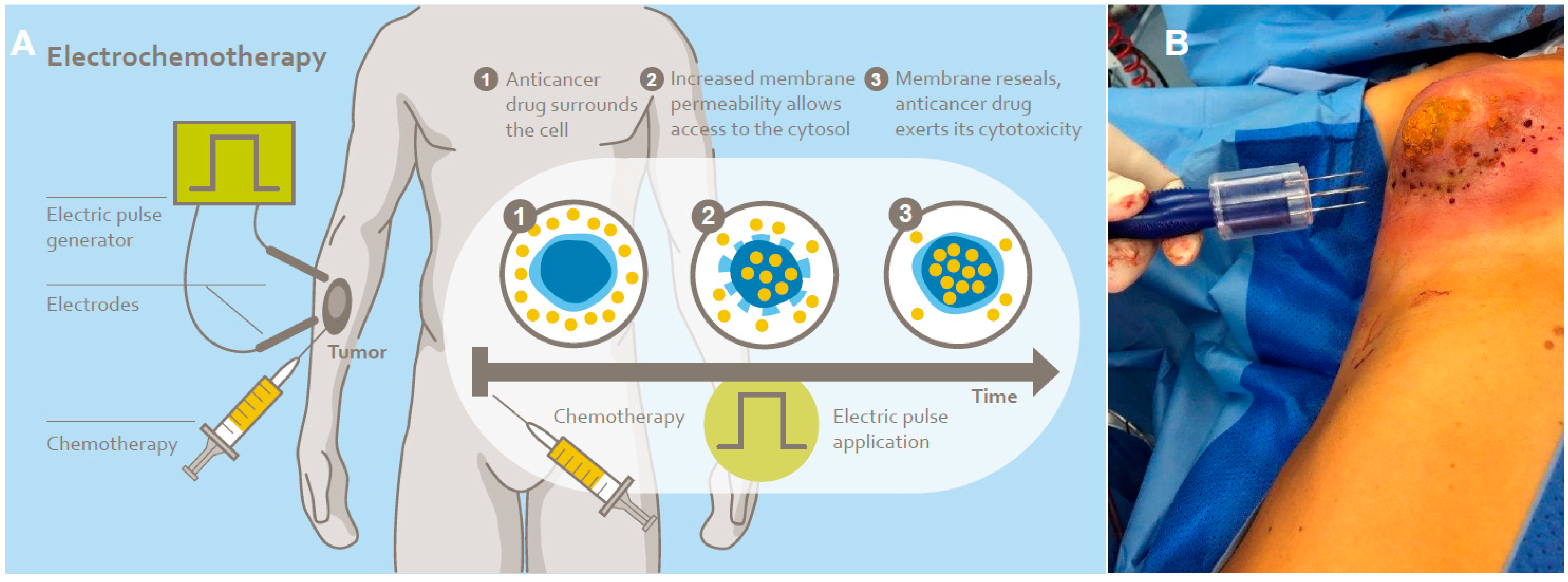 Mechanism of Reversible Electroporation with Chemotherapy