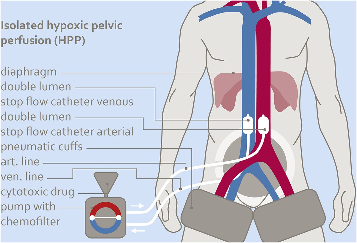 Scheme of hypoxic isolated pelvic perfusion b Contrast imaging of pelvic vessels after balloon blocking