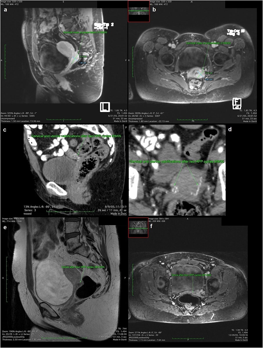 (a, b) Cervical mass at presentation, (c, d) Extensive calcifications in the cervix and uterus after two HPP cycles, (e, f) Residual cervical mass after four HPP cycles.