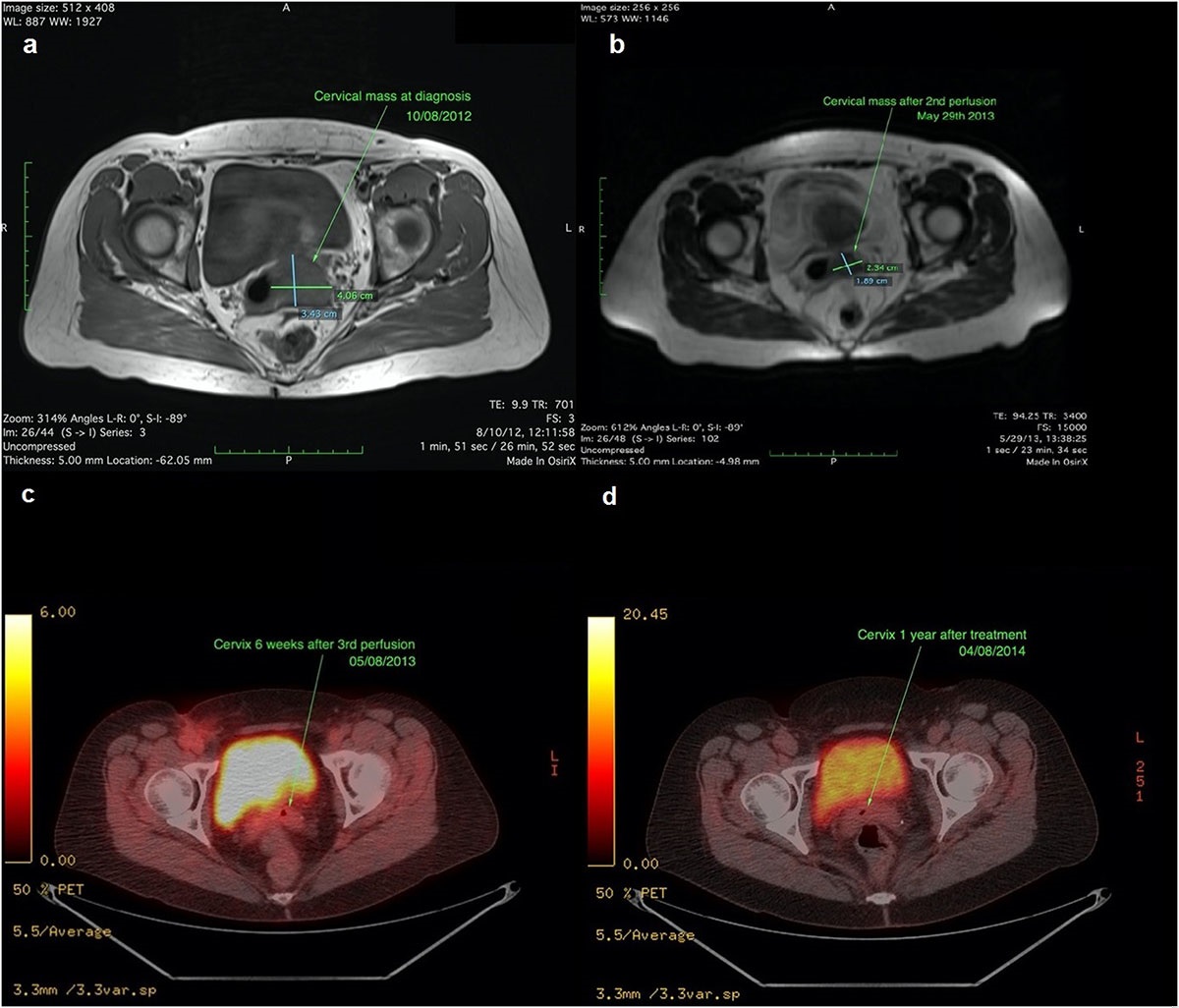 (a) Cervical mass at diagnosis in August of 2012 (left) and (b) after the 1st HPP, (c, d) FDG PET-CT two months after 3rd treatment (left) and one year after (right).