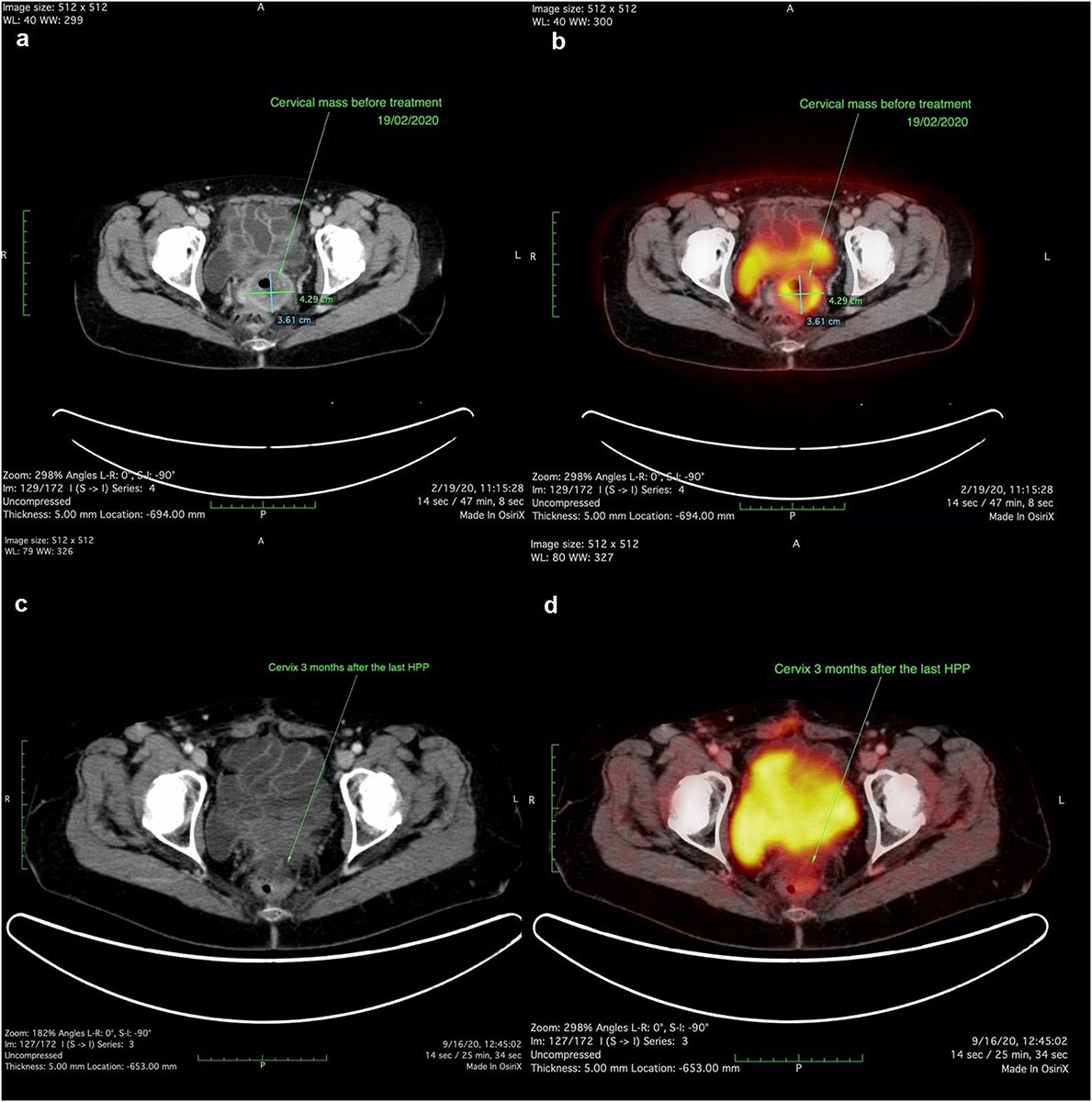 (a, b) cervical mass before treatment on contrast-enhanced CT and FDG PET-CT, (c, d) cervix 3 months after the last HPP.