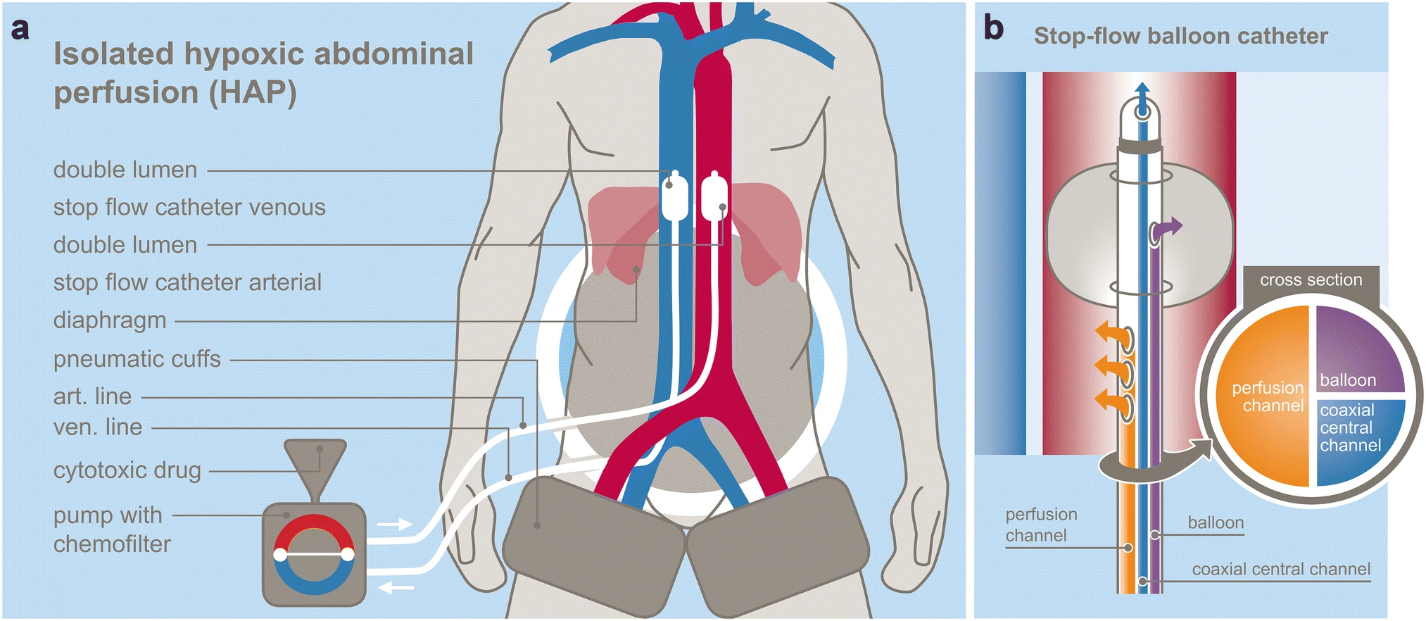 Technique of upper abdominal hypoxic perfusion with chemofiltration (UAP-F)